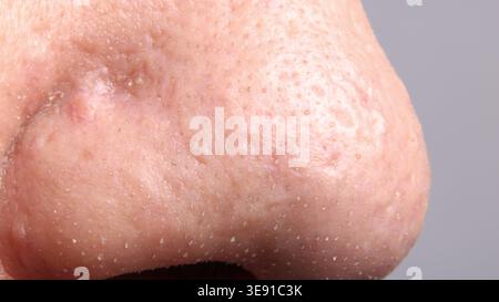 Mitesser Akne. Makronahmebild von Gesichtshaut und Nase. Sichtbare Poren Mitesser Akneflecken und Hautstruktur. Ideal für Hautpflege-Dermat Stockfoto