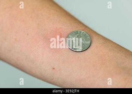 Eine Nahaufnahme des linken ventralen Unterarms einer Person zeigt eine lokalisierte Hautreaktion auf einen Mückenstich, wobei ein US-Viertel für die Skala 2024 platziert wurde. Bild mit freundlicher Genehmigung von CDC. Stockfoto