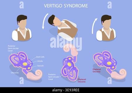 3D Isometrischer Flachvektor konzeptuelle Darstellung des Vertigo-Syndroms, BPPV Stockfoto