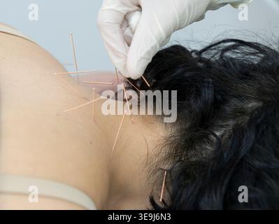 Arzt mit Handschuhen entfernt mehrere Akupunkturnadeln aus dem Hals- und Schulterbereich der weiblichen Patientin nach der Behandlung. Stockfoto