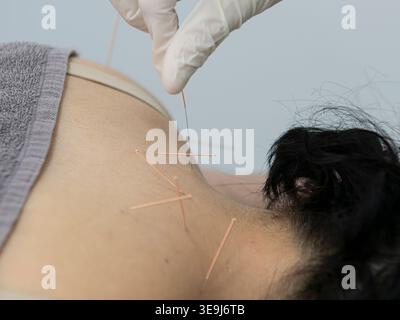 Arzt mit Handschuhen entfernt mehrere Akupunkturnadeln aus dem Hals- und Schulterbereich der weiblichen Patientin nach der Behandlung. Stockfoto