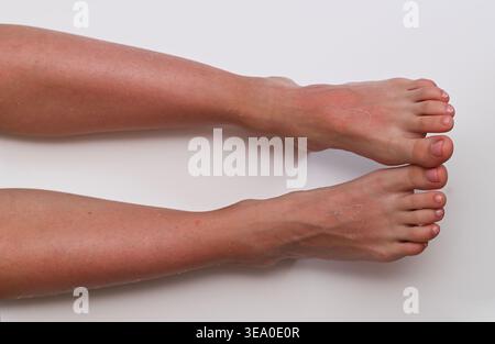 Nahaufnahme von Füßen mit Sonnenbrand, Ablösung der Haut und sichtbare Rötung, Reizung durch längere Sonneneinstrahlung, Konzentration auf Hautschäden und Erholungsprozess, Stockfoto