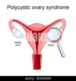 Polyzystisches Ovarialsyndrom. Gesundes Ovar, PCOS, Uterus und Vergrößerungsglas. Reproduktive Gesundheit. Vektorabbildung. Medizinisches Diagramm. Stock Vektor