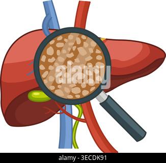 Lebererkrankungen. Leberzirrhose unter einem Vergrößerungsglas. Vektorillustration menschlicher Organe. Anatomie und Medizin Stock Vektor
