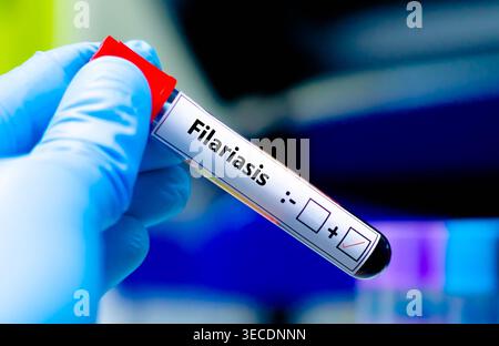 Blutprobe des Patienten-positiven Befundes bei Filariasis. Stockfoto