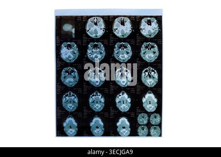 Gehirn-ct-Scan mit axialen Ansichten für medizinische und diagnostische Zwecke Stockfoto