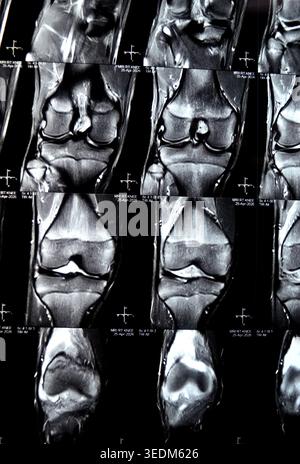MRT des rechten Knies mit patellofemoralen nodulären Weichteilverdickungen, subkortikalem Marködem, Kontusion der unteren Patellarpole, Grad 2 si Stockfoto