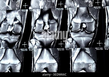 MRT des rechten Knies mit patellofemoralen nodulären Weichteilverdickungen, subkortikalem Marködem, Kontusion der unteren Patellarpole, Grad 2 si Stockfoto