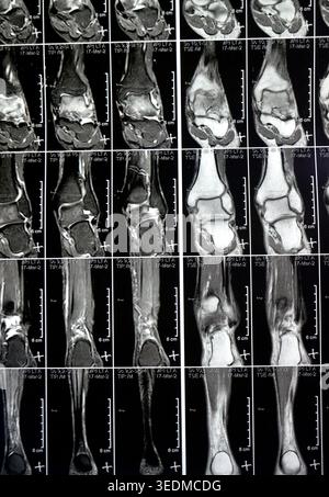 MRT linkes Sprunggelenk mit gut definierter, abgerundeter juxtakortischer knöcherner Läsion, die den Talarhals mit einem ausgeprägten umliegenden Knochenmarködem, Osteo, betrifft Stockfoto