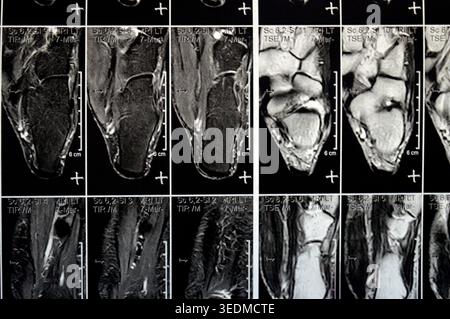 MRT linkes Sprunggelenk mit gut definierter, abgerundeter juxtakortischer knöcherner Läsion, die den Talarhals mit einem ausgeprägten umliegenden Knochenmarködem, Osteo, betrifft Stockfoto