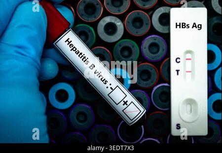 Blutprobe eines Patienten-positiven HBsAg-Ergebnisses. Stockfoto
