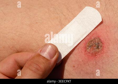 Nahaufnahme einer Hand, die ein medizinisches Pflaster über eine rote Hautläsion zum Schutz und zur Heilung legt Stockfoto