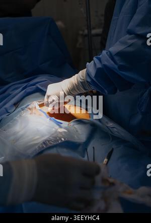 Nahaufnahme von Chirurgen, die Wundverschlüsse mit Nadelhalter und Operationsfaden durchführen. Fachärzte für sterile Handschuhe und blaue Kittel Stockfoto