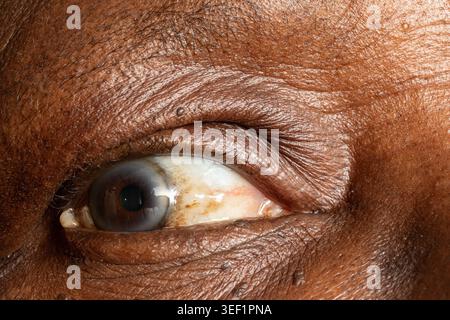 Nahaufnahme eines menschlichen Auges mit dunkler Haut, die Alterserscheinungen zeigt Stockfoto