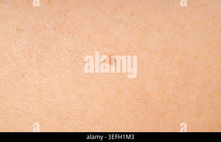 Hautmole Spotcloseup. Menschliches Muttermal, gutartiger Naevus oder Makrotextur des Maulwurfs, potenzielles Melanom oder Krebs für das dermatologische Design Stockfoto