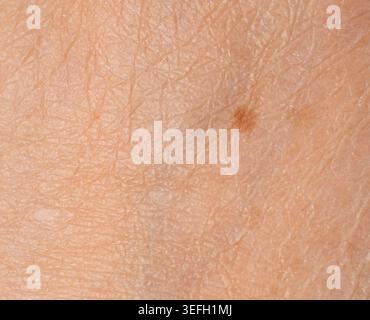 Hautmole Spotcloseup. Menschliches Muttermal, gutartiger Naevus oder Makrotextur des Maulwurfs, potenzielles Melanom oder Krebs für das dermatologische Design Stockfoto