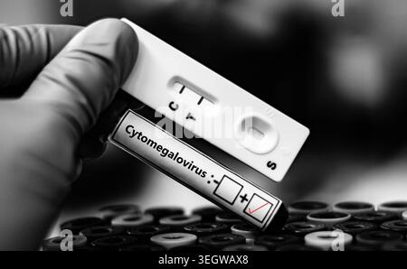 Blutprobe von Patienten-positivem Ergebnis für Cytomegalievirus. Stockfoto