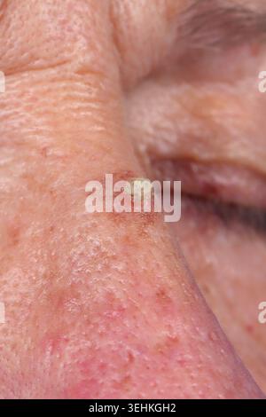 Invasives Plattenepithelkarzinom der Nase, das sich auf aktinischer Keratose bei einer 77-jährigen Frau entwickelt. Stockfoto