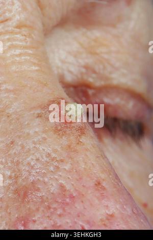 Invasives Plattenepithelkarzinom der Nase, das sich auf aktinischer Keratose bei einer 77-jährigen Frau entwickelt. Stockfoto