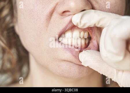 Weibliche kaukasische Erwachsenenzahnuntersuchung mit Handschuhen Nahzähnen Stockfoto