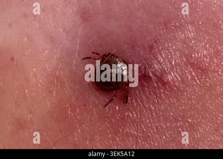 Nahaufnahme einer einsamen Sternzecke (Amblyomma americanum), die in die menschliche Haut eingebettet ist und den charakteristischen weißen dorsalen Fleck und lokalisierte Irritationen an der Bissstelle zeigt. Fotografiert in Olathe, Kansas, am 28. Juni 2025. Stockfoto