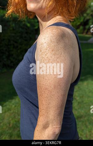 Seitenansicht von gerafftem Arm und Schulter einer hellhäutigen rothaarigen Frau Stockfoto