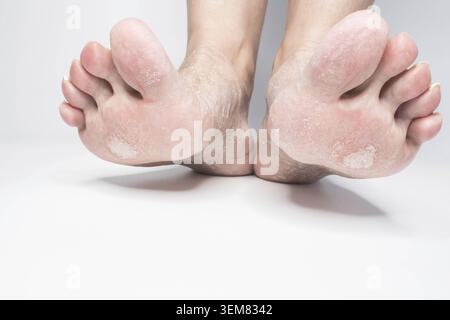 Nahaufnahme der weiblichen Wunden der Füße, trockene Fersen isoliert auf weißem Hintergrund Stockfoto