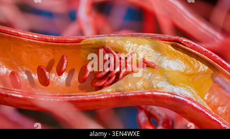 Cholesterin oder atherosklerotische Plaques in Blutgefäßen, verstopfter Gefäßschlaganfall, verdickte Arterien und Venen, Koronargefäße, Fettablagerungen, die verstopfen, Atheros Stockfoto