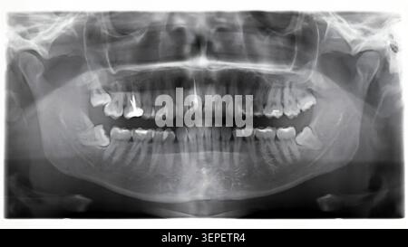 Das breite Panorama-Röntgenbild zeigt obere und untere Zähne, Kieferknochen und Zahnarbeiten für eine umfassende orale Beurteilung. Stockfoto