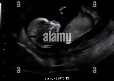 Die Ultraschalluntersuchung des Babys zeigt das Wachstum eines Fetus während einer Schwangerschaftsuntersuchung in einer medizinischen Einrichtung. Stockfoto