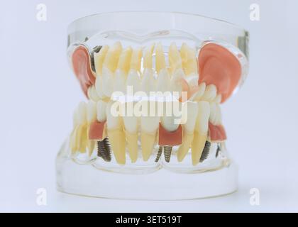 Transparentes Kiefermodell zur Demonstration von Implantatrestaurationen und Zahnanatomie Stockfoto