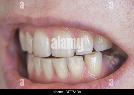 Menschliche Zähne Zeigen Okklusion Und Zahnfleischränder Im Engen Mund Ansicht Mit Emaille-Textur Und Ausrichtung Innerhalb Der Mundhöhle, Lippen Zurückgezogen, Natürliche Färbung, Zahnperspektive. Stockfoto