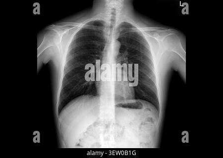 Thorax-Röntgenaufnahme PA-Ansicht mit Lungen, Rippen und Schultern für die medizinische Diagnose. Klinische radiologische Untersuchung, Atemwegsuntersuchung, orthopädische Beurteilung Stockfoto