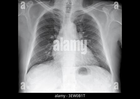 Thorax-Röntgenaufnahme PA-Ansicht mit Lungen, Rippen und Schultern für die medizinische Diagnose. Klinische radiologische Untersuchung, Atemwegsuntersuchung, orthopädische Beurteilung Stockfoto
