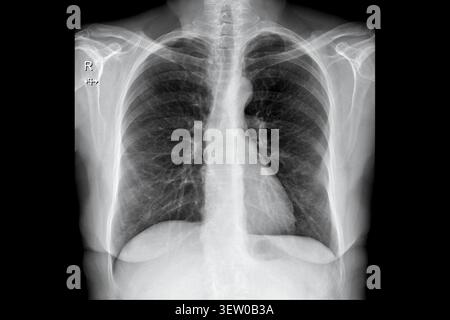 Thorax-Röntgenaufnahme PA-Ansicht mit Lungen, Rippen und Schultern für die medizinische Diagnose. Klinische radiologische Untersuchung, Atemwegsuntersuchung, orthopädische Beurteilung Stockfoto
