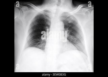Thorax-Röntgenaufnahme PA-Ansicht mit Lungen, Rippen und Schultern für die medizinische Diagnose. Klinische radiologische Untersuchung, Atemwegsuntersuchung, orthopädische Beurteilung Stockfoto
