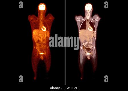 PET-CT oder Kernscan eines Patienten mit normalem Ganzkörperskelett. Fortgeschrittene Diagnostik in der Nuklearmedizin und molekularen Bildgebung. Stockfoto