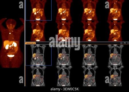 PET-CT oder Kernscan eines Patienten mit normalem Ganzkörperskelett. Fortgeschrittene Diagnostik in der Nuklearmedizin und molekularen Bildgebung. Stockfoto