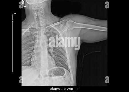 Thorax X-ray PA-Ansicht mit Lungen, Rippen und Schultern für die medizinische Diagnose. Klinische radiologische Untersuchung, Atemgesundheit und orthopädische Beurteilung. Stockfoto