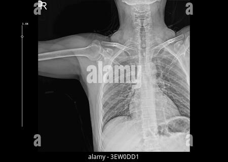 Thorax X-ray PA-Ansicht mit Lungen, Rippen und Schultern für die medizinische Diagnose. Klinische radiologische Untersuchung, Atemgesundheit und orthopädische Beurteilung. Stockfoto