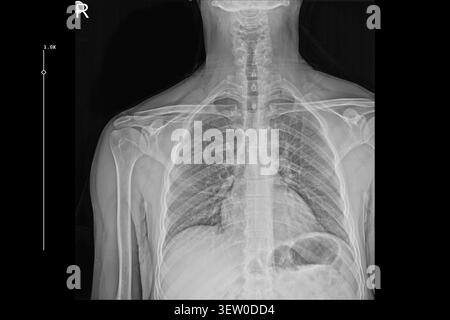 Thorax X-ray PA-Ansicht mit Lungen, Rippen und Schultern für die medizinische Diagnose. Klinische radiologische Untersuchung, Atemgesundheit und orthopädische Beurteilung. Stockfoto