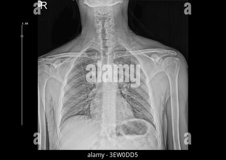 Thorax X-ray PA-Ansicht mit Lungen, Rippen und Schultern für die medizinische Diagnose. Klinische radiologische Untersuchung, Atemgesundheit und orthopädische Beurteilung. Stockfoto