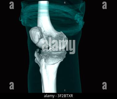 Farbige dreidimensionale Computertomographie (CT)-Rekonstruktion, die einen Tibiaplateau-Fraktur zeigt. Eine Tibiaplateau-Fraktur ist ein Bruch im oberen Teil der Tibia (Schienbein) auf Höhe des Kniegelenks. Diese Frakturen gehen oft mit Weichteilverletzungen einher, einschließlich Schäden an den Bändern und Menisken des Knies. Symptome umfassen Schmerzen, Schwellungen und Schwierigkeiten beim Belasten des Beins. Die Behandlung hängt von der Schwere ab und kann von Ruhigstellung und Physiotherapie bis hin zu einer Operation zur Wiederherstellung der Ausrichtung und Stabilität des Kniegelenks reichen. Stockfoto