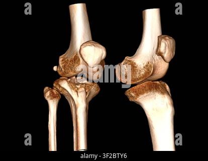 Farbige dreidimensionale Computertomographie (CT)-Rekonstruktion, die einen Tibiaplateau-Fraktur zeigt. Eine Tibiaplateau-Fraktur ist ein Bruch im oberen Teil der Tibia (Schienbein) auf Höhe des Kniegelenks. Diese Frakturen gehen oft mit Weichteilverletzungen einher, einschließlich Schäden an den Bändern und Menisken des Knies. Symptome umfassen Schmerzen, Schwellungen und Schwierigkeiten beim Belasten des Beins. Die Behandlung hängt von der Schwere ab und kann von Ruhigstellung und Physiotherapie bis hin zu einer Operation zur Wiederherstellung der Ausrichtung und Stabilität des Kniegelenks reichen. Stockfoto