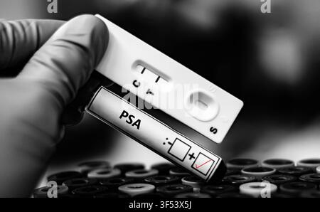 Blutprobe eines Patienten mit positivem PSA-Ergebnis. Stockfoto