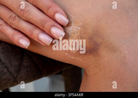 Nahaufnahme von weiblichen Fingern, die klare Salbe oder Gel auf ein dunkles Hämatom auf der Haut auftragen. Detaillierte Ansicht der medizinischen Behandlung eines Beinkontusions unter natu Stockfoto