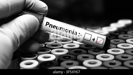 Blutprobe eines Patienten mit positivem Befund für Pneumonie. Stockfoto