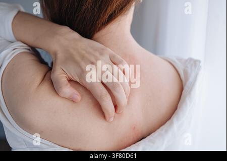Nahaufnahme des Frauenrückens mit roter Hautreizung und allergischer Rötung, dermatologisches Krankheitskonzept. Hochwertiges Foto Stockfoto
