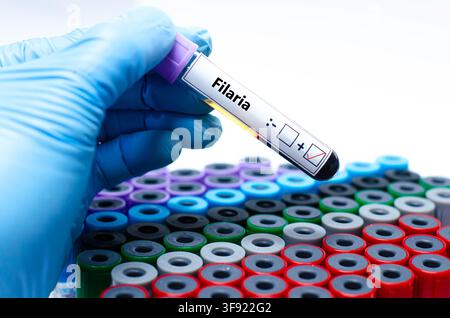 Blutprobe des Patienten-positiven Filarienergebnisses. Stockfoto