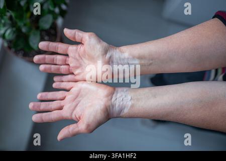 Nahaufnahme von Händen mit Vitiligo, die sichtbare Hautdepigmentierung zeigen, natürlicher Pigmentierungskontrast. Stockfoto